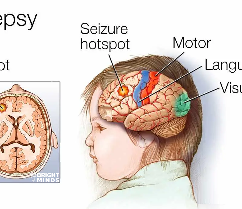 Epilepsy